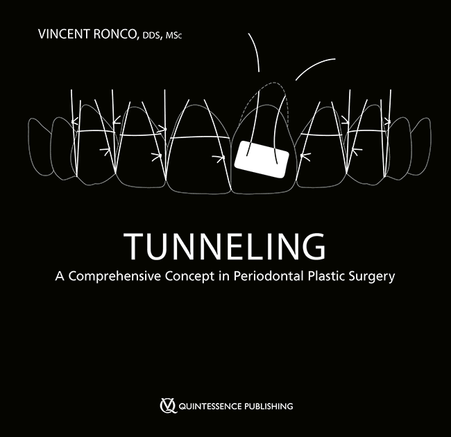 Tunneling: A Comprehensive Concept in Periodontal Plastic Surgery (Scanned Copy)