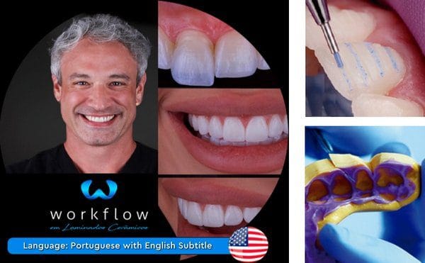 Ceramic Veneers Workflow