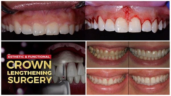 Esthetic and Functional Crown Lengthening Course
