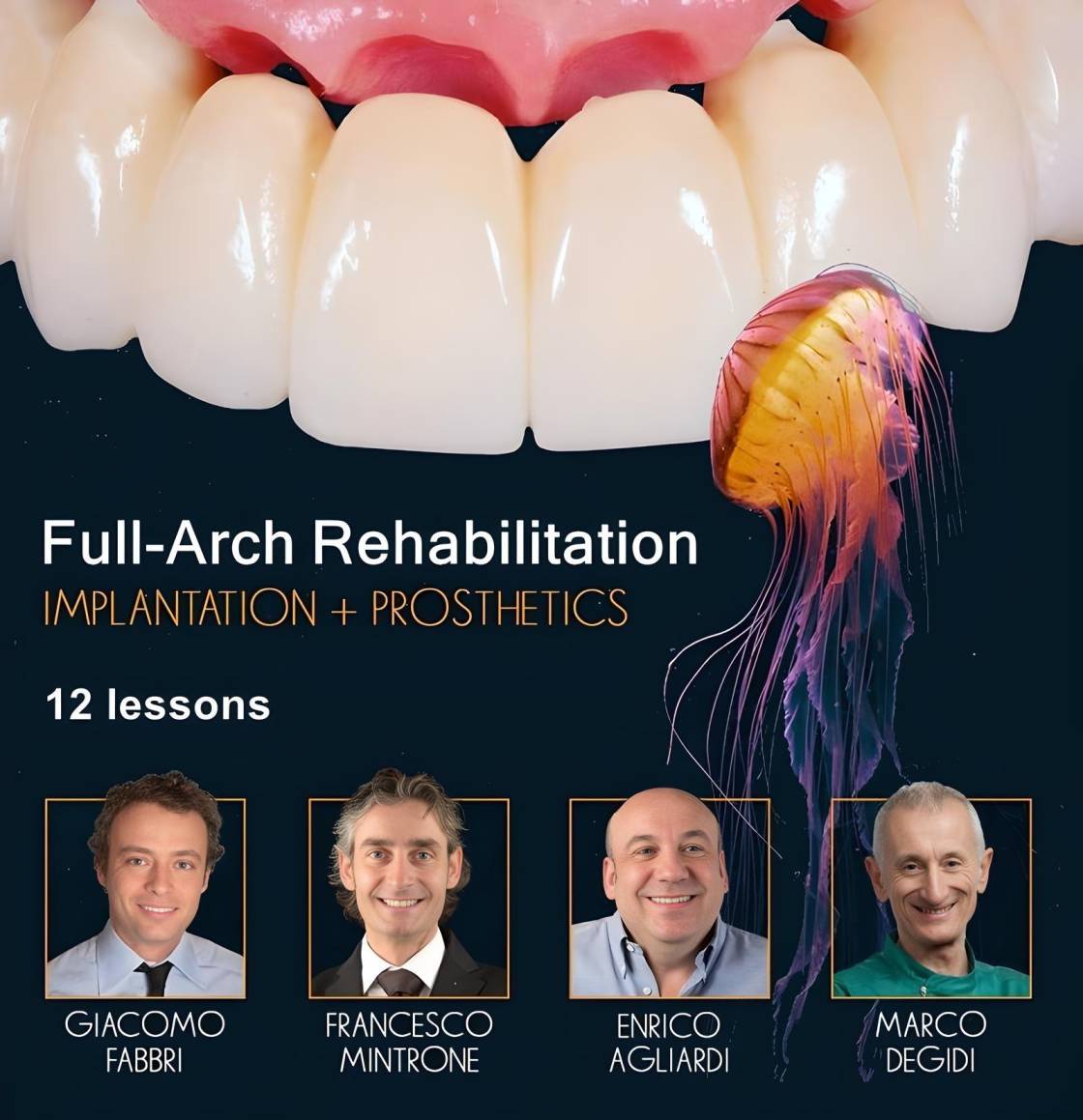 Full-Arch Rehabilitation: Implantation and Prosthetics