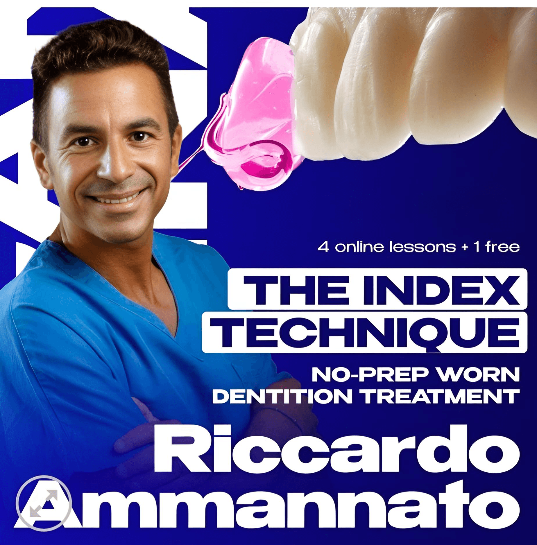 The Index Technique. No-prep Worn Dentition Treatment