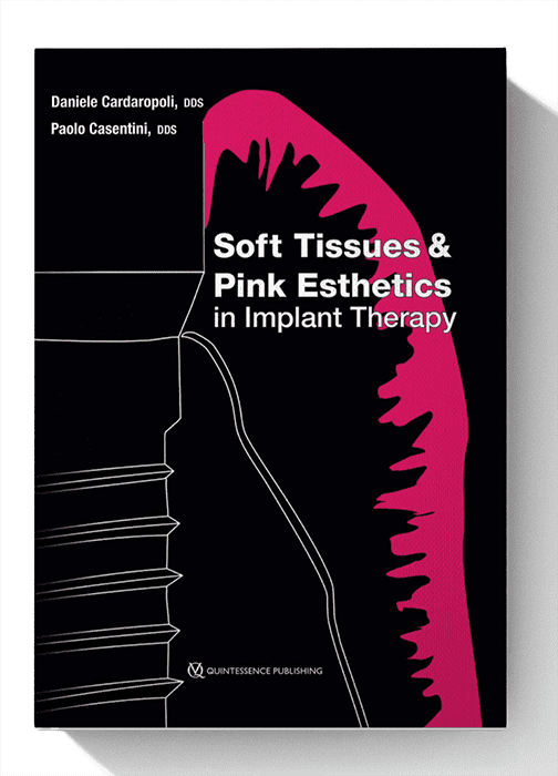 Soft Tissues and Pink Esthetics in Implant Therapy 1st Edition
