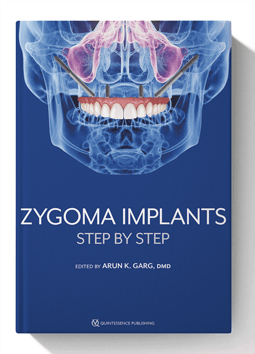 Zygoma Implants: Step by Step 1st Edition