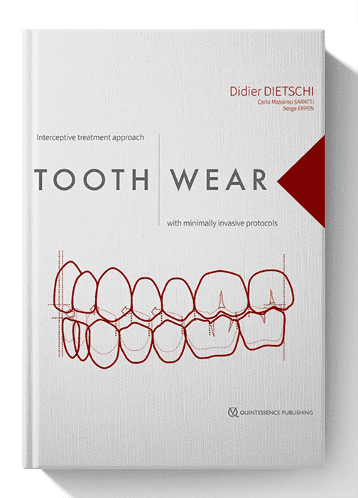 Tooth Wear: Interceptive Treatment Approach With Minimally Invasive Protocols