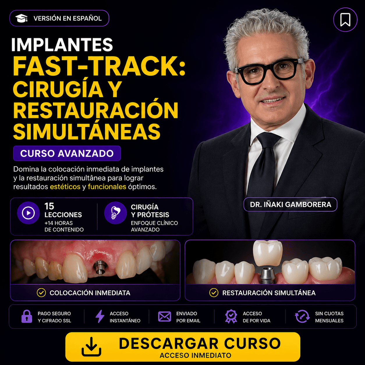 Implantes Fast-Track: Cirugía y Restauración Simultáneas